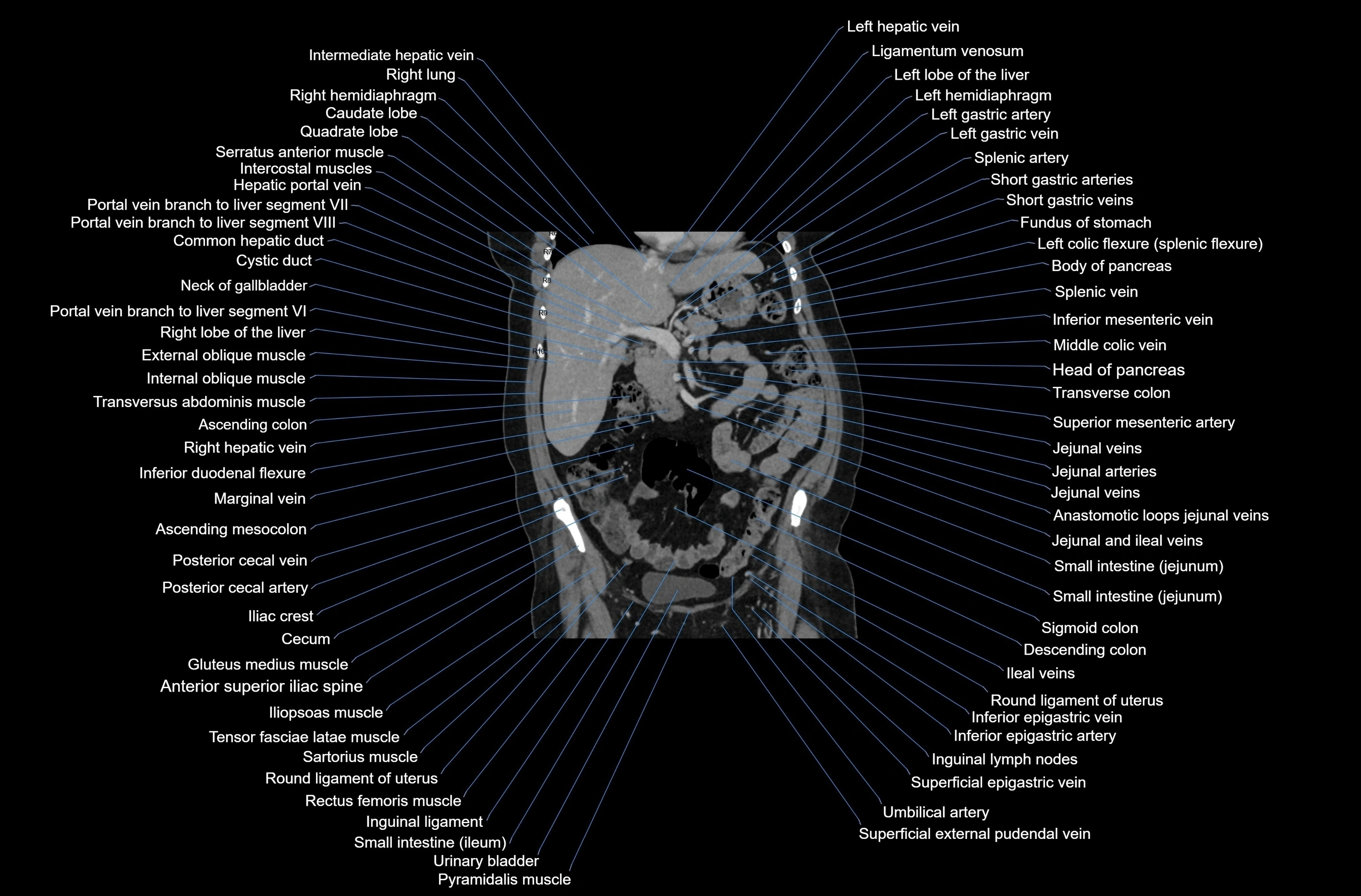 CT abdomen coronal cross sectional anatomy labelled radiology image-00036.webp